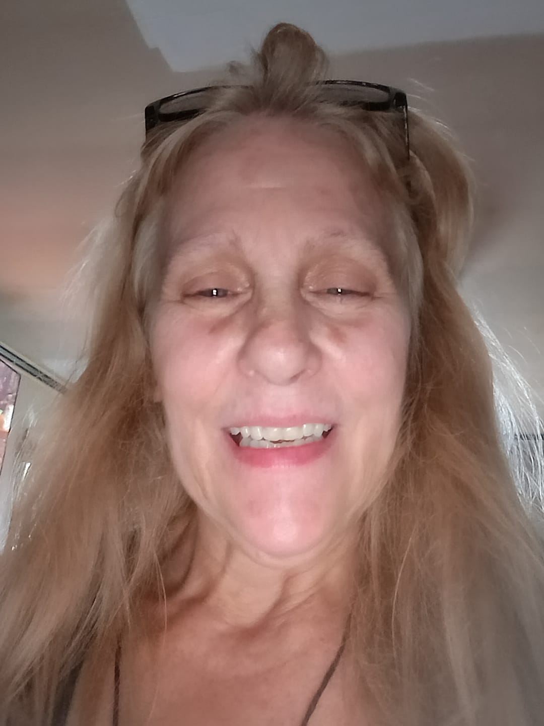 Customer photo review of Acrylic Partial Flipper Denture