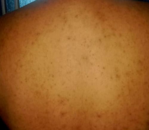 Customer photo review of Clear Skin Check