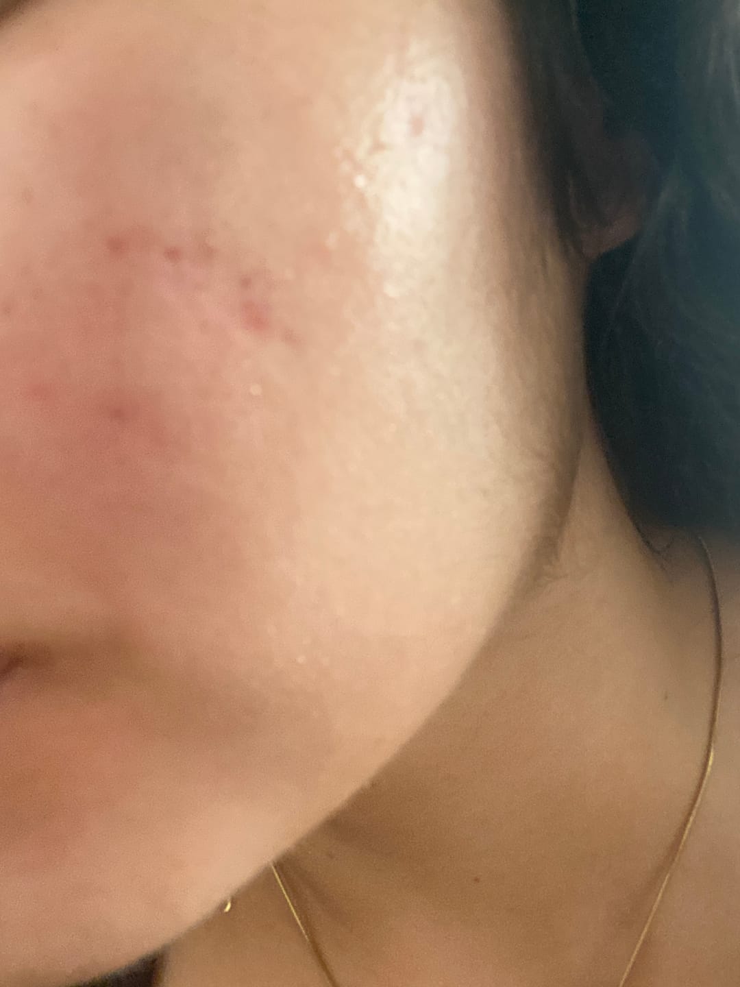 Customer photo review of A CONTROL - ACNÉ HORMONAL & RESISTENCIA A LA INSULINA