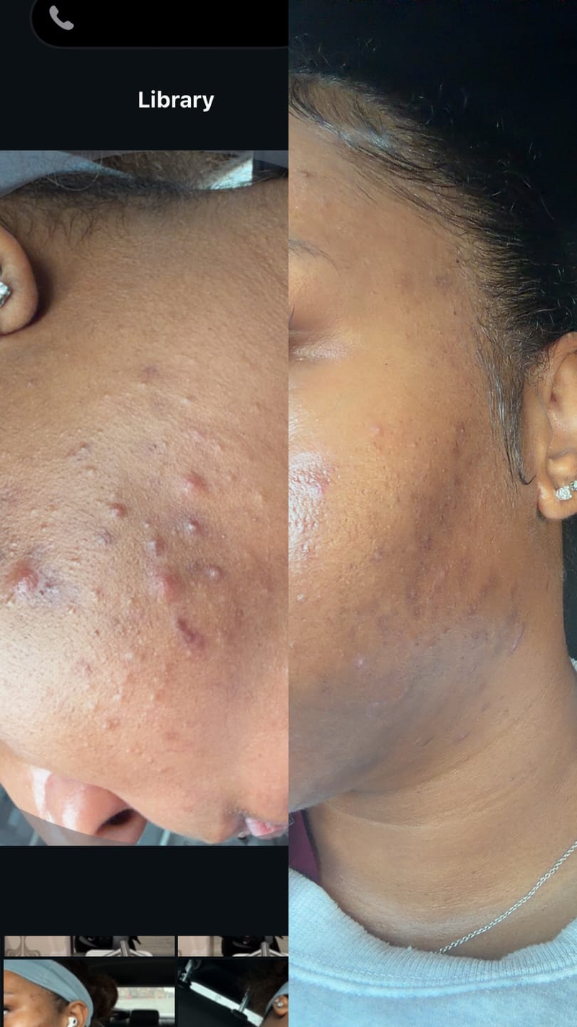 Customer photo review of Duo Skincare Bundle
