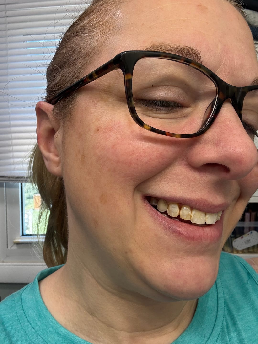 Customer photo review of Clear Unilateral Partial Denture