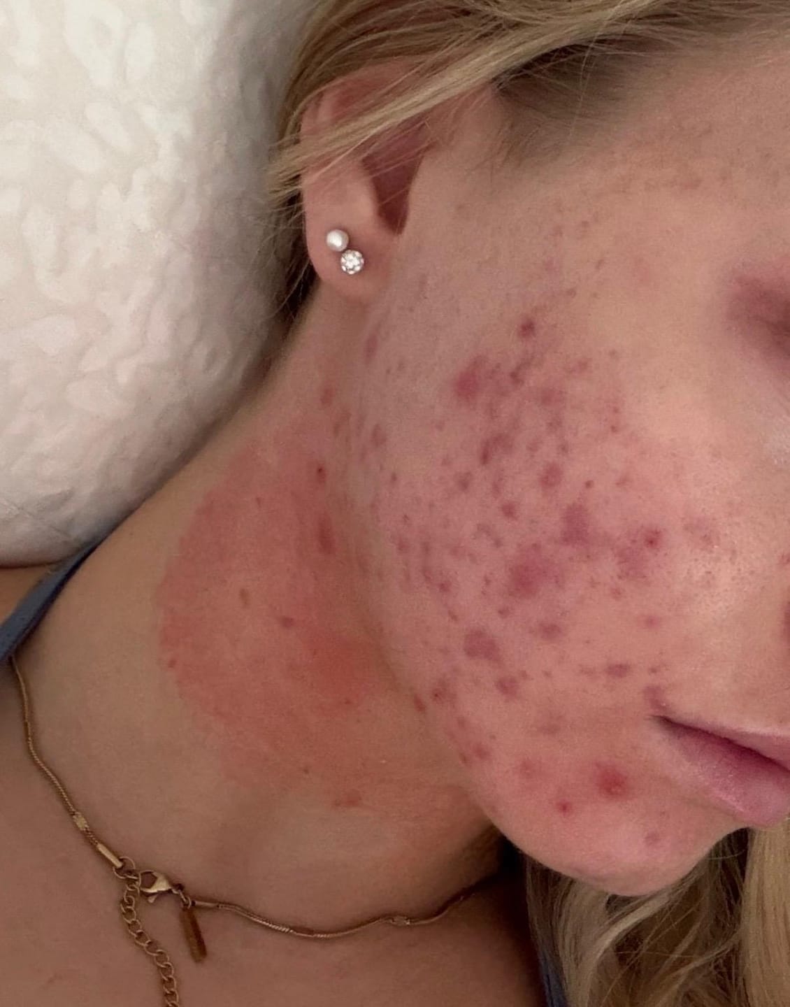 Customer photo review of Clear Skin Serum + BHA