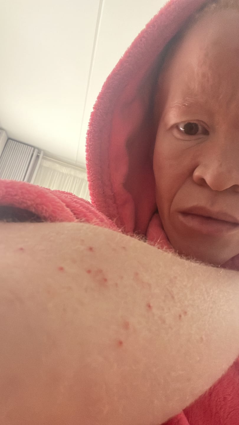 Customer photo review of Acne Pack