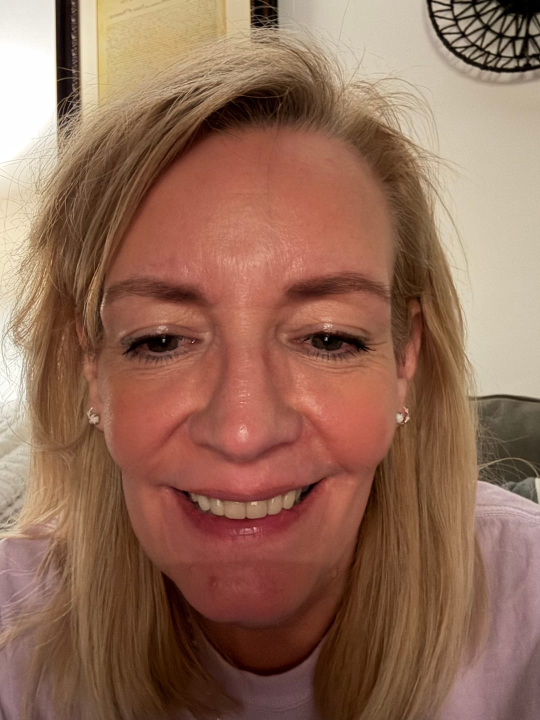 Customer photo review of Unilateral Partial Denture
