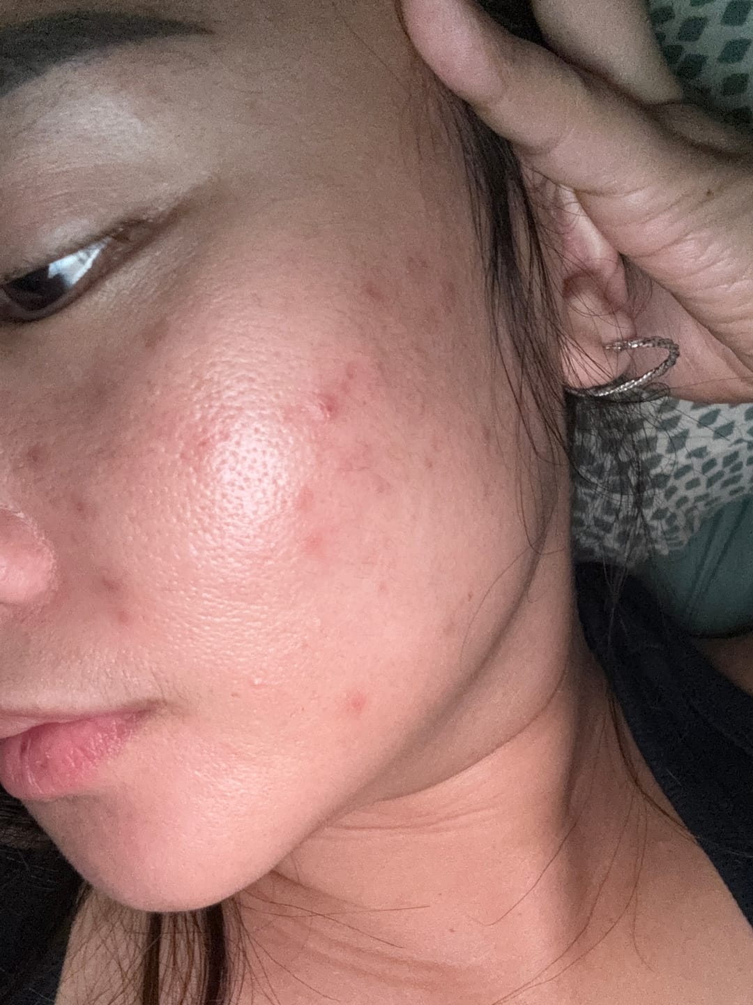 Customer photo review of Skin Clearing Honey & Turmeric Bar