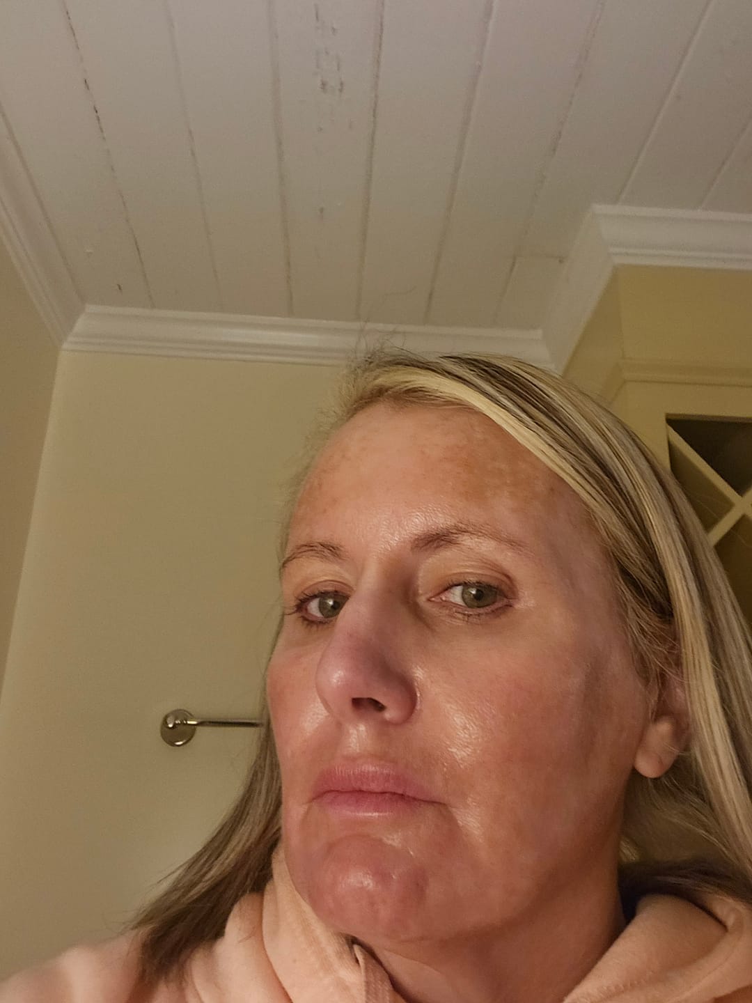 Customer photo review of Hydra Pen H6 Advanced Serum Infusion Microneedling Pen with Light Therapy