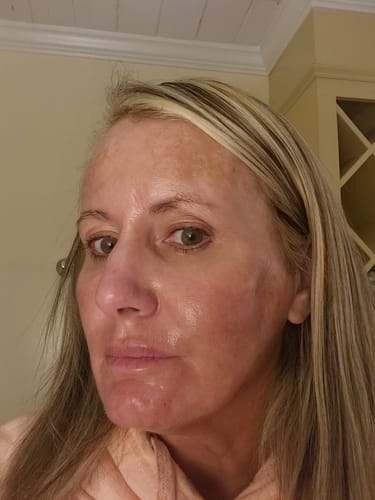 Customer photo review of ASCE Plus SRLV Exosome Advanced Skin Booster with ExoSCRT™ Technology