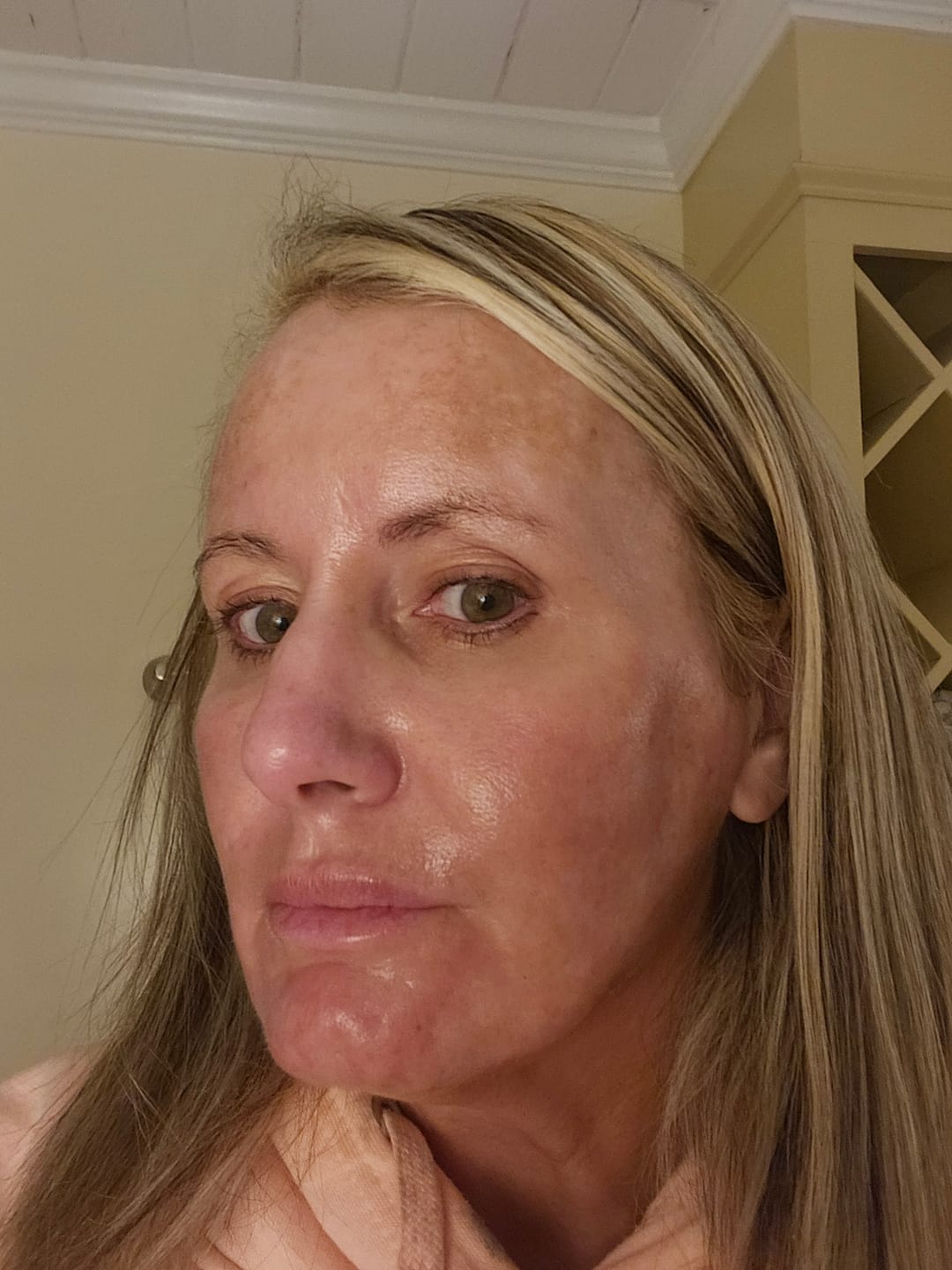 Customer photo review of ASCE Plus SRLV Exosome Advanced Skin Booster with ExoSCRT™ Technology