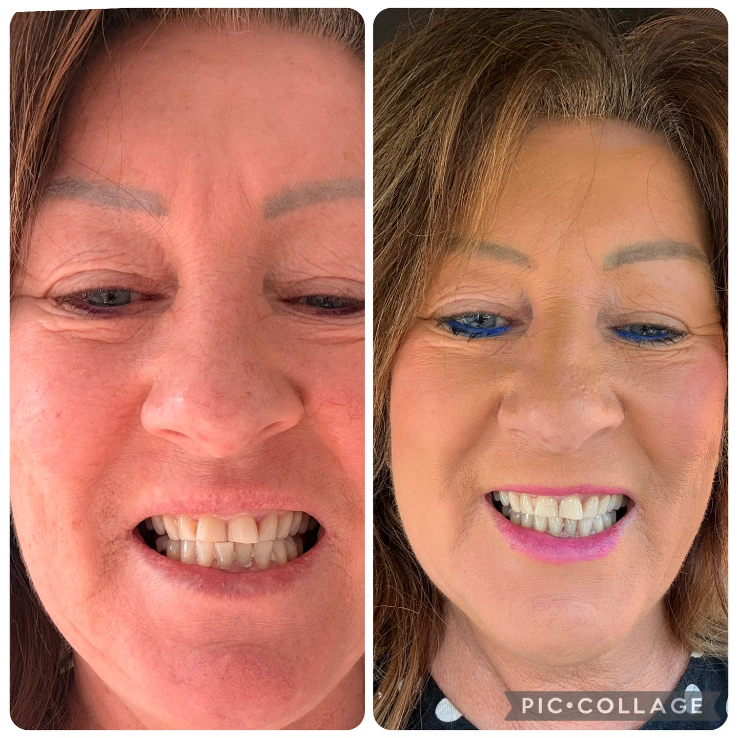 Customer photo review of Teeth Whitening Pen