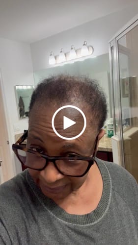 Customer video review of 4 bottle of Rennora Hair Growth Serum