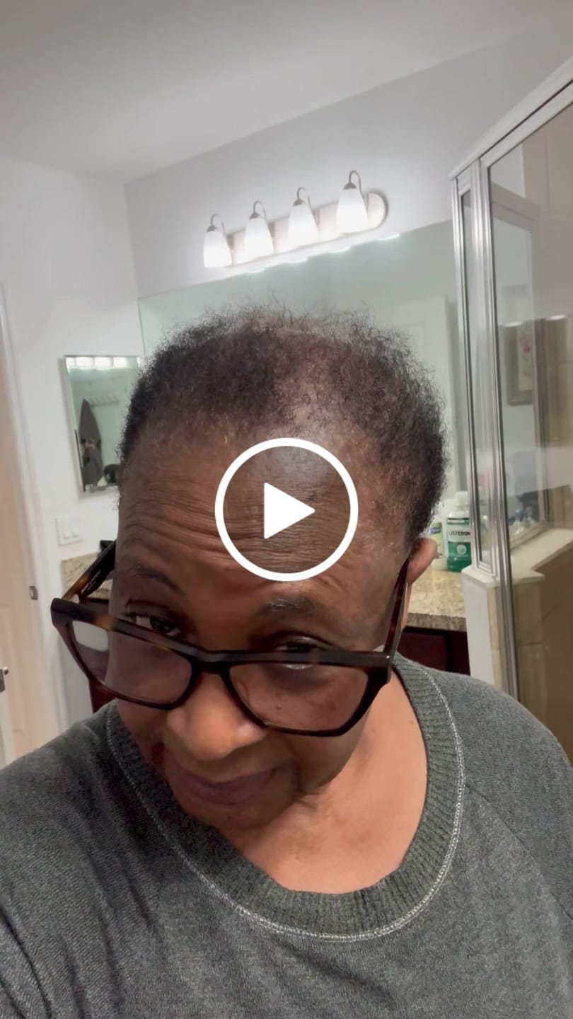 Customer video review of 4 bottle of Rennora Hair Growth Serum