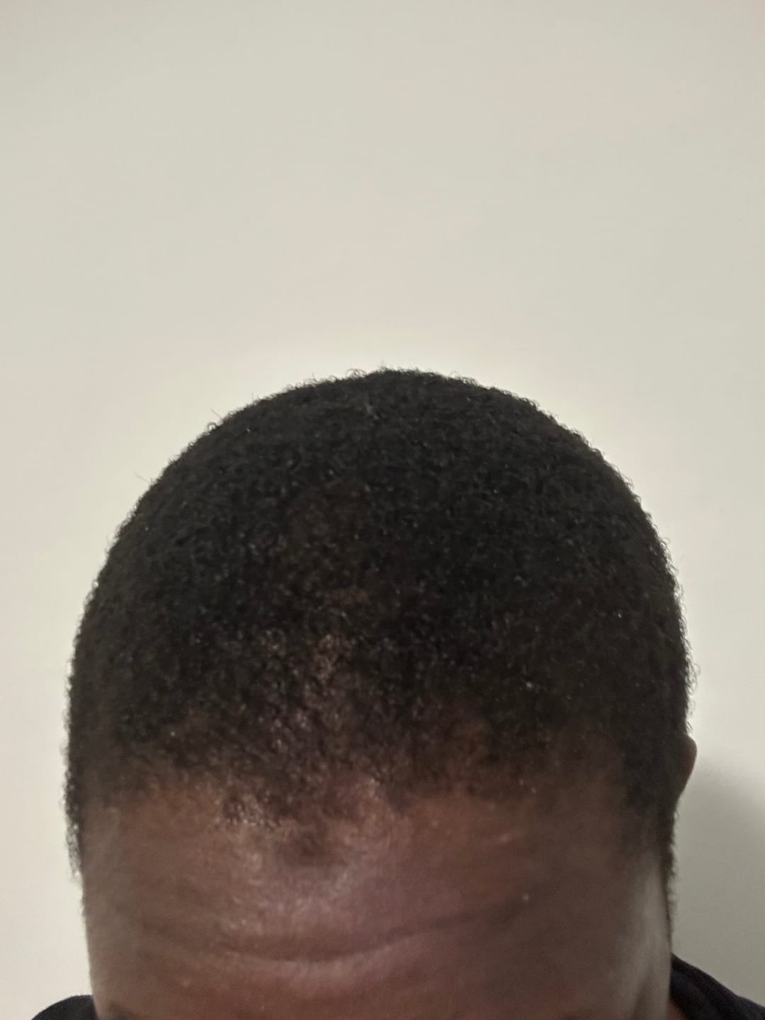 Customer photo review of Minoxidil 5% + DHT Blocker Solution - MEN ONLY, 3 Month supply