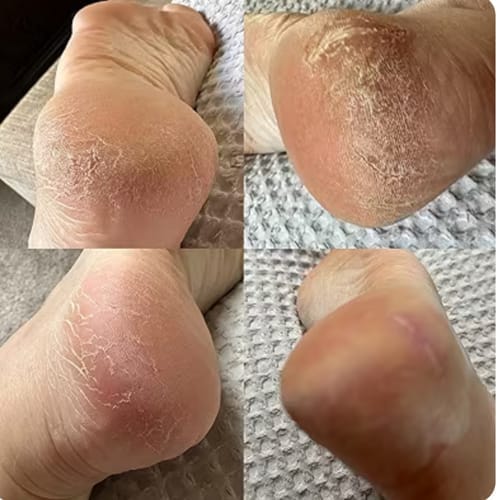 Customer photo review of ™Pedi - מכונה להסרת עור יבש וסדקים בכפות הרגליים
