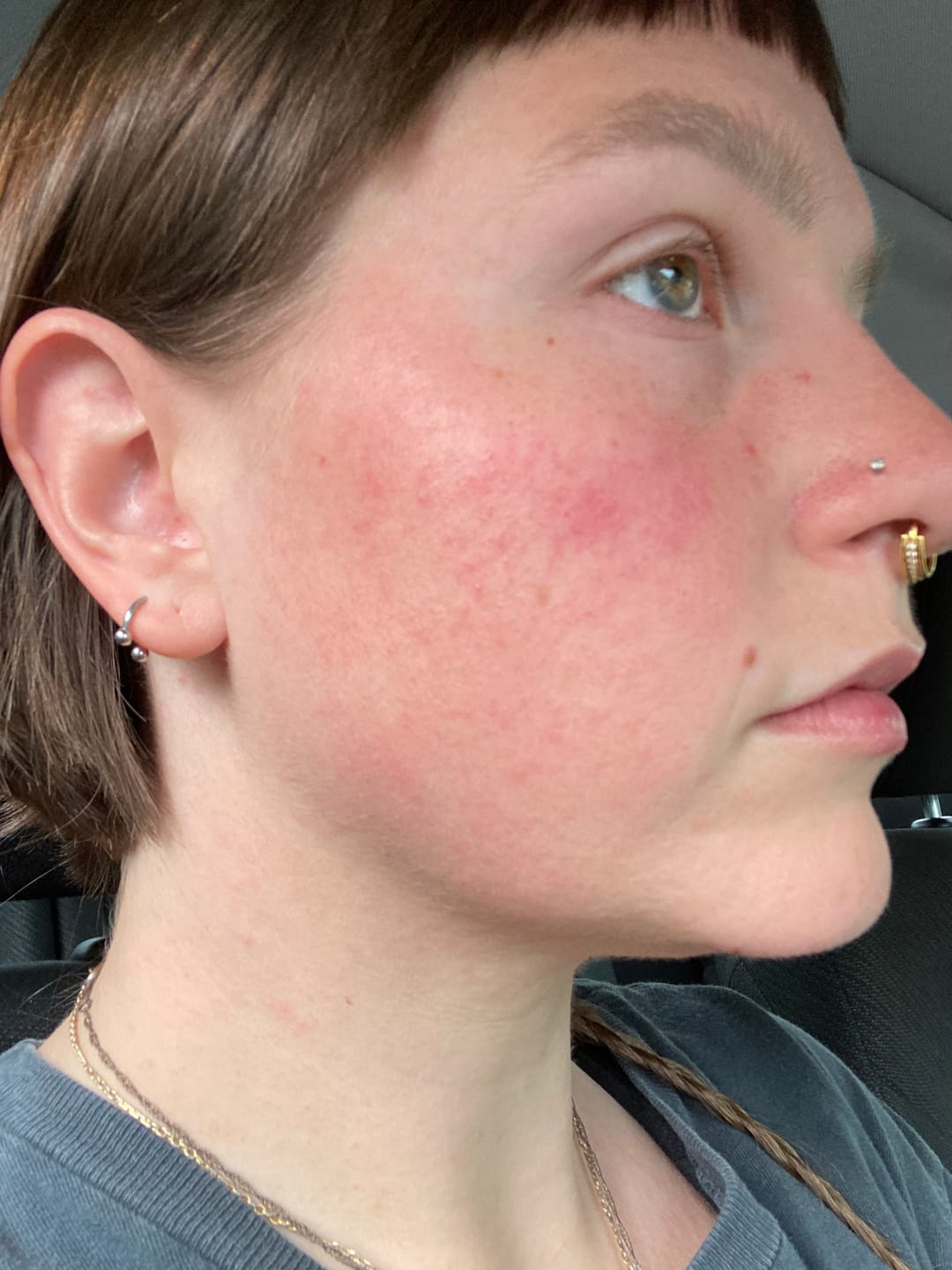 Customer photo review of Rosacea-Ltd IV