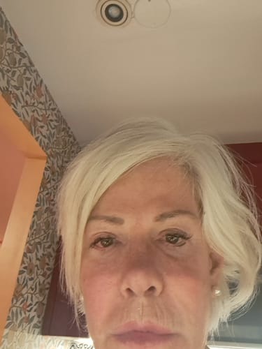 Customer photo review of WrinkleFix: Botox (Existing Customers)