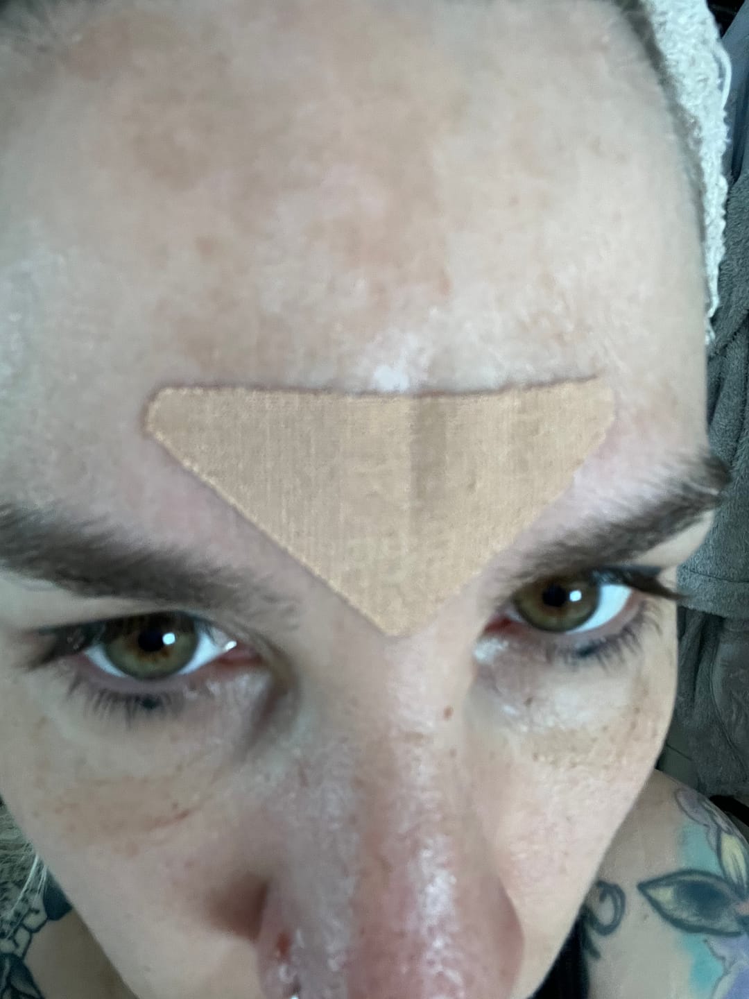 Customer photo review of Zornesfalten Patches mit Hyaluron