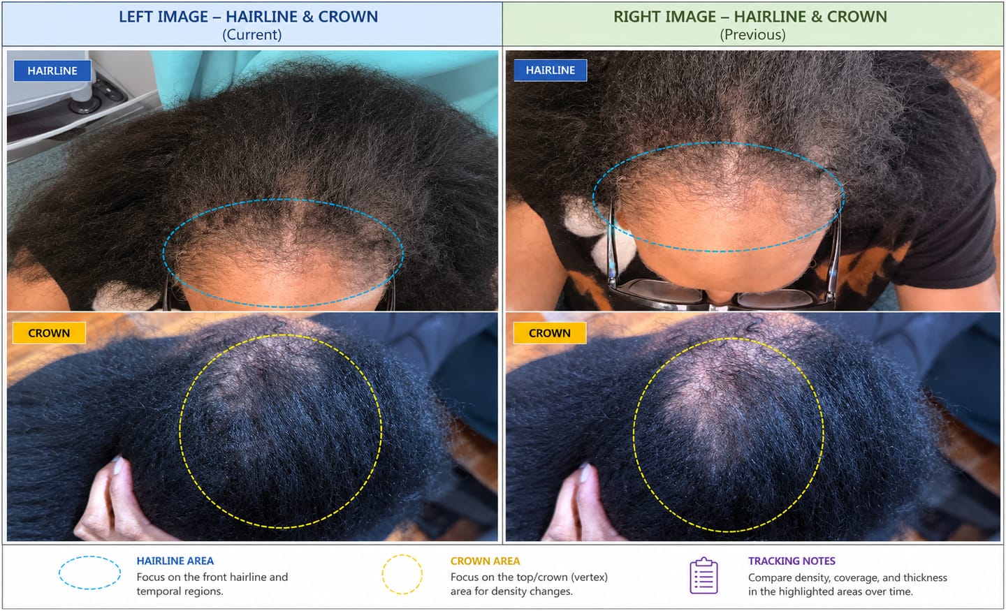 Customer photo review of Triple Growth Kit (Curly & Coily) BOGO