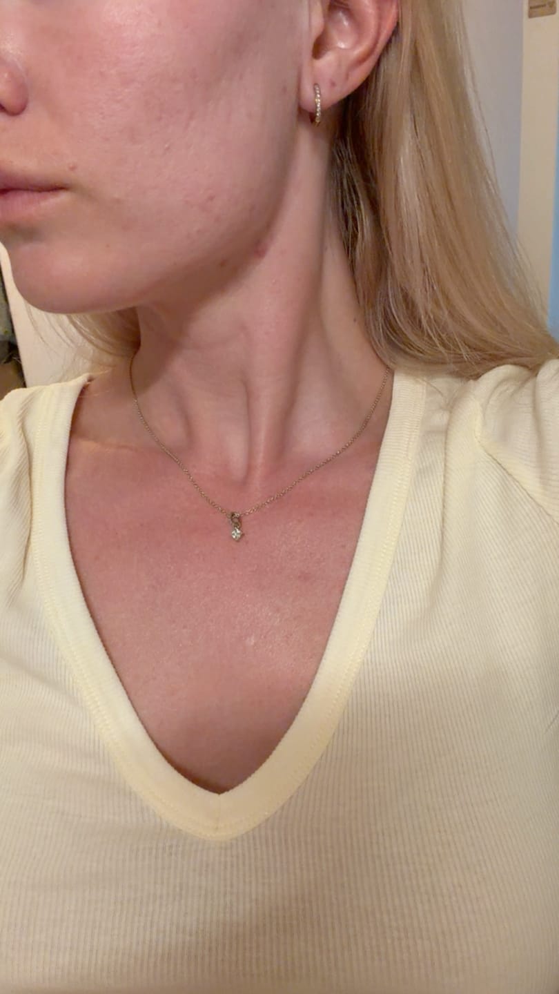 Customer photo review of Acne Formula