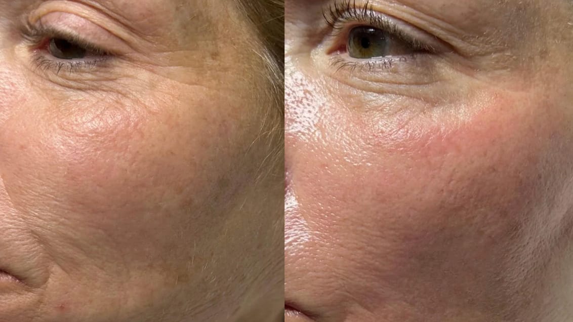 Customer photo review of Hyaluron Gesichtsmaske