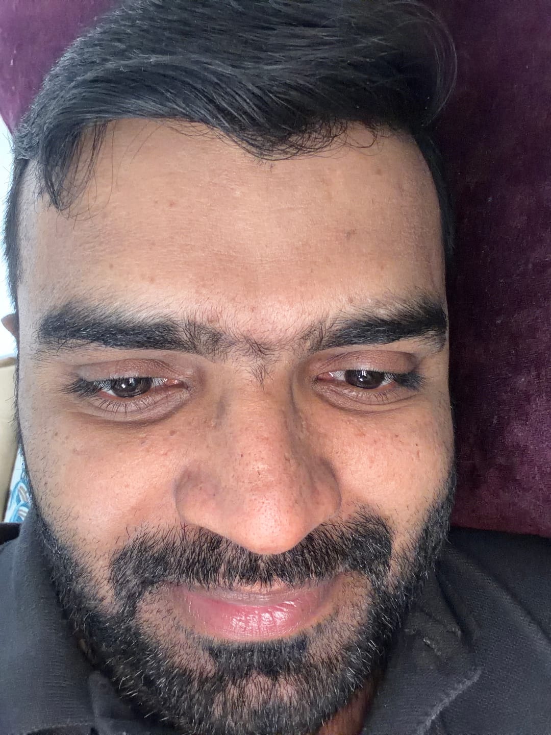 Customer photo review of Mela Care Advanced Brightening Cream Double Pack Bundle