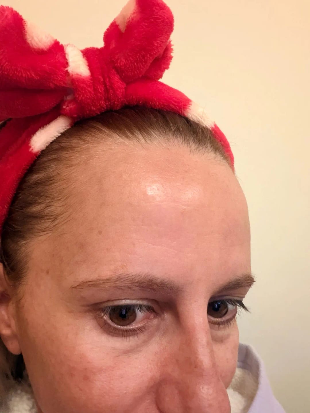 Customer photo review of Microneedling-Infusion Treatment <strong>für zuhause</strong> - Lifting Power Set
