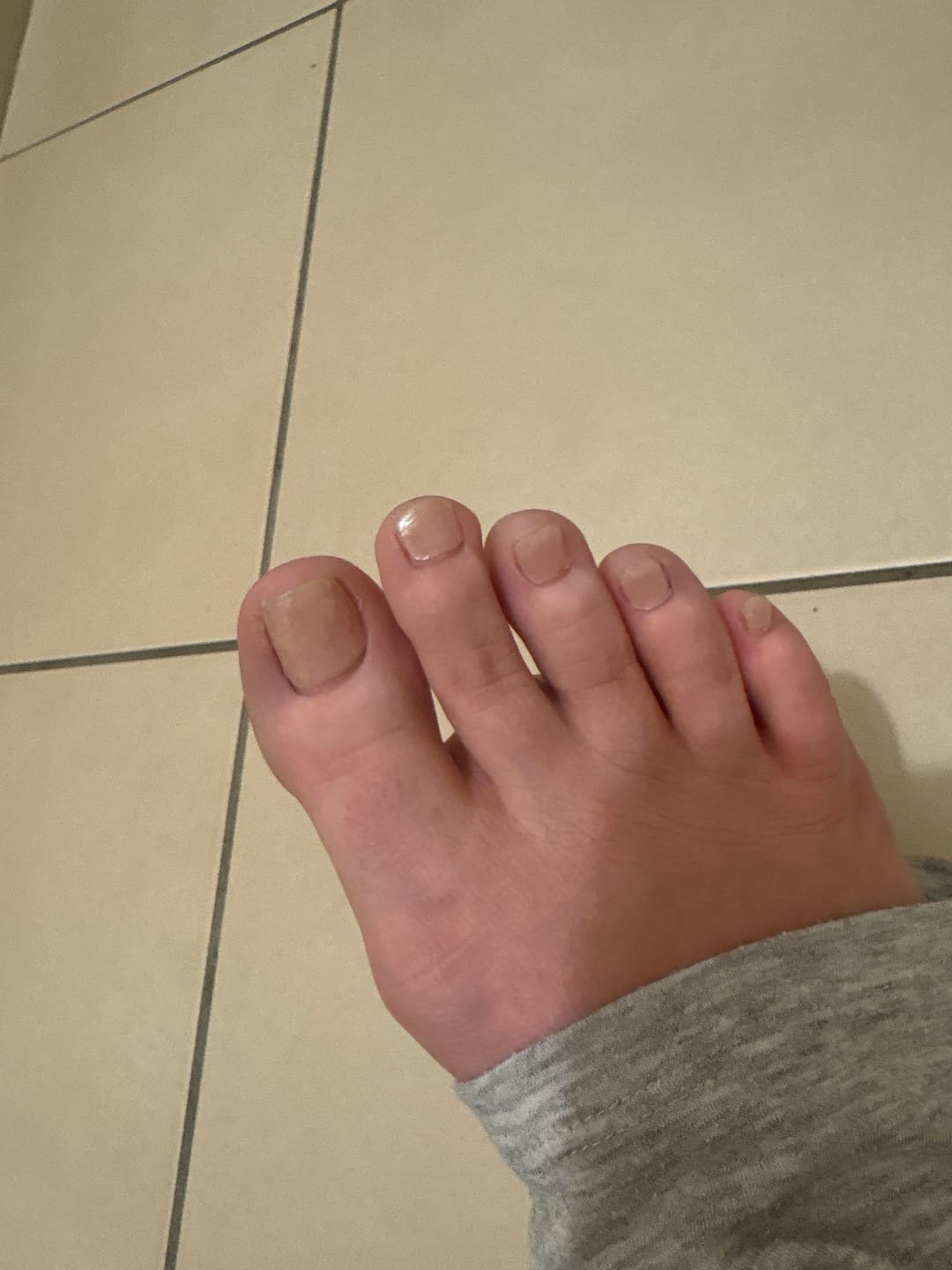 Customer photo review of (PEDI/TOES)  Pink Hailey Glazed Donut Semicured Gel Nail Sticker Kit