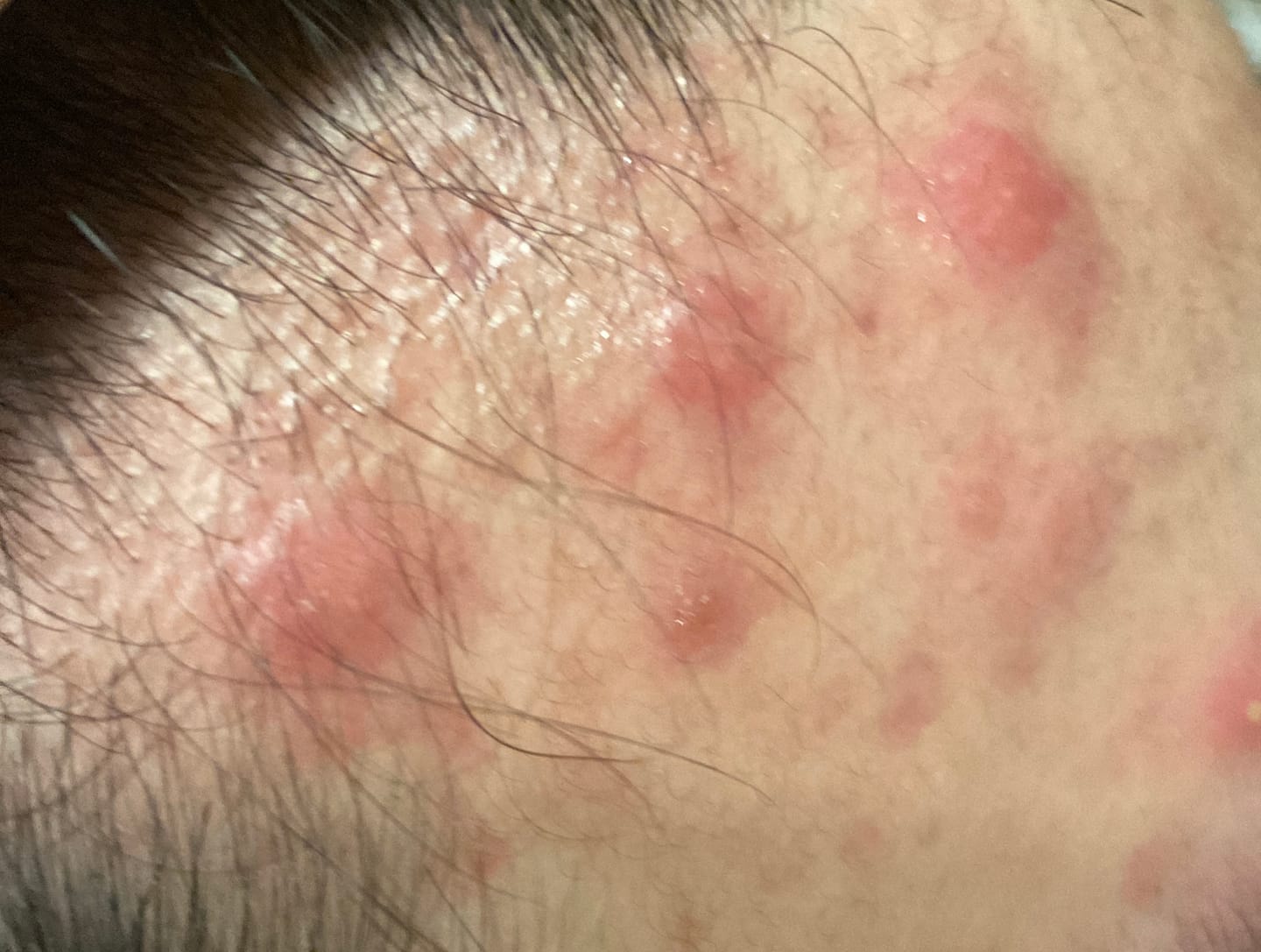 Customer photo review of Ventamin Clear It+: Doctor-Formulated Drink Mix for Acne & Breakout Control