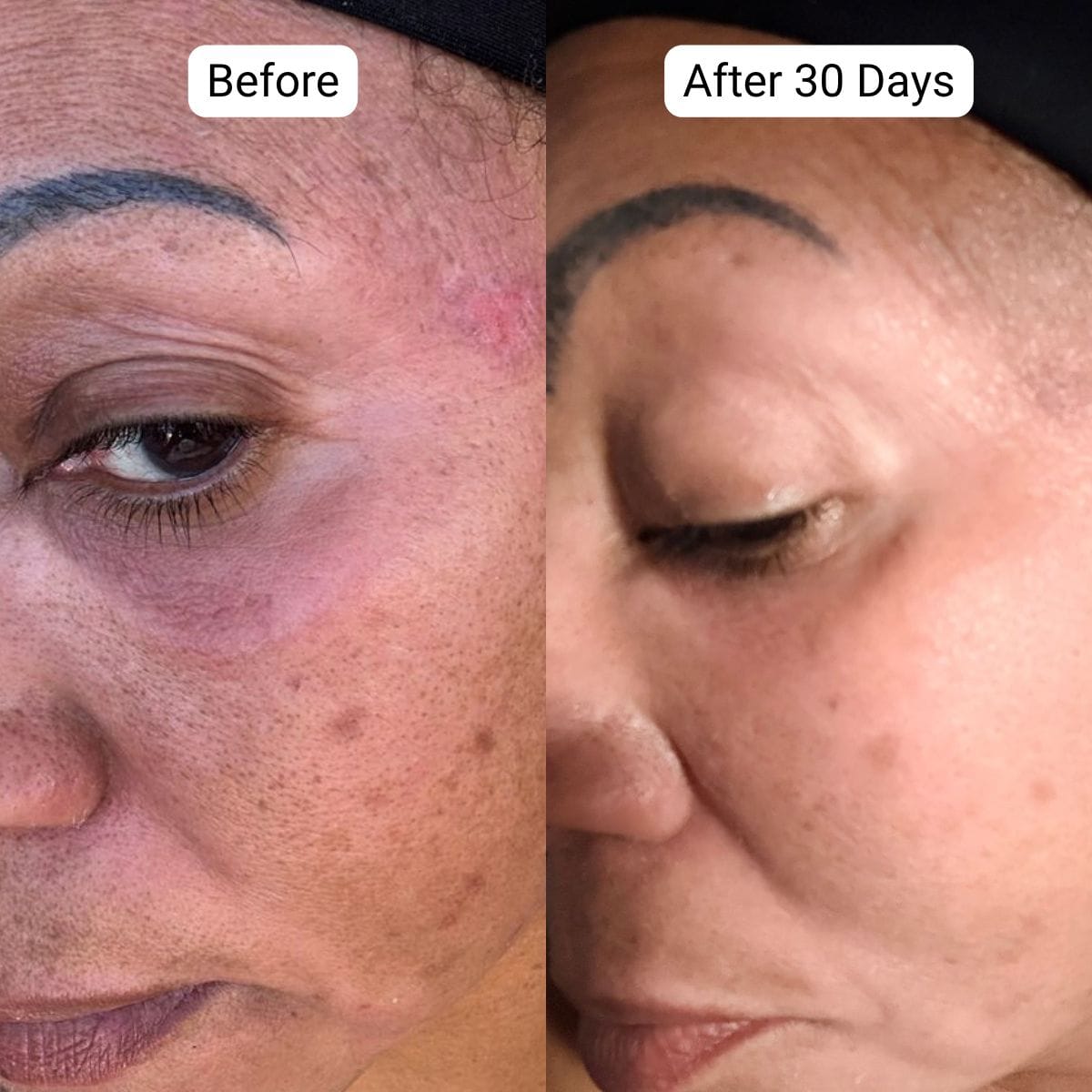 Customer photo review of Omic+ 10% Tranexamic Acid Face Serum - Fade Dark Spots Fast 30ml