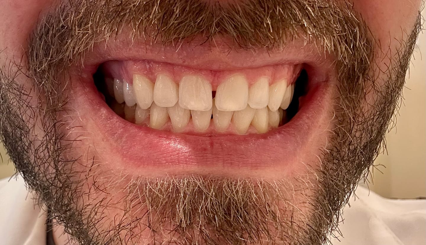 Customer photo review of Whitening Syringe Kit Sample