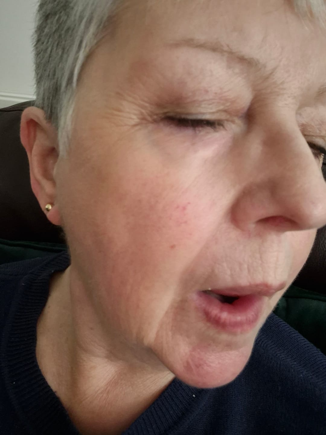 Customer photo review of Rosalique 3 in 1 Anti-Redness Miracle Formula SPF50