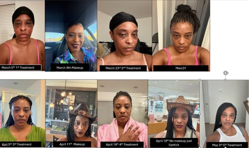 Customer's photo timeline showing facial skin progress from March to May after using The Micro Infusion System.