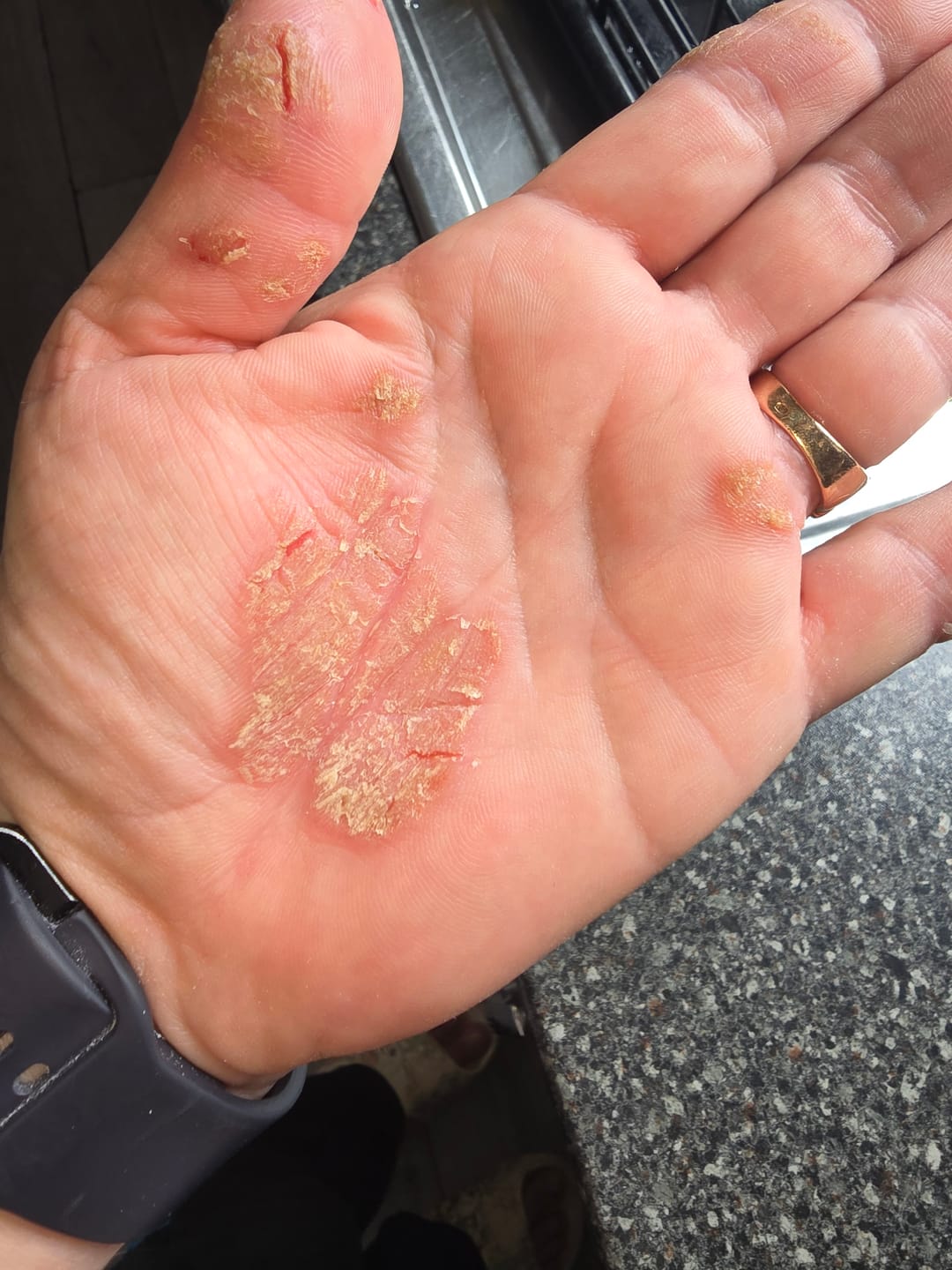 Customer photo review of Bioskin Duo Pack