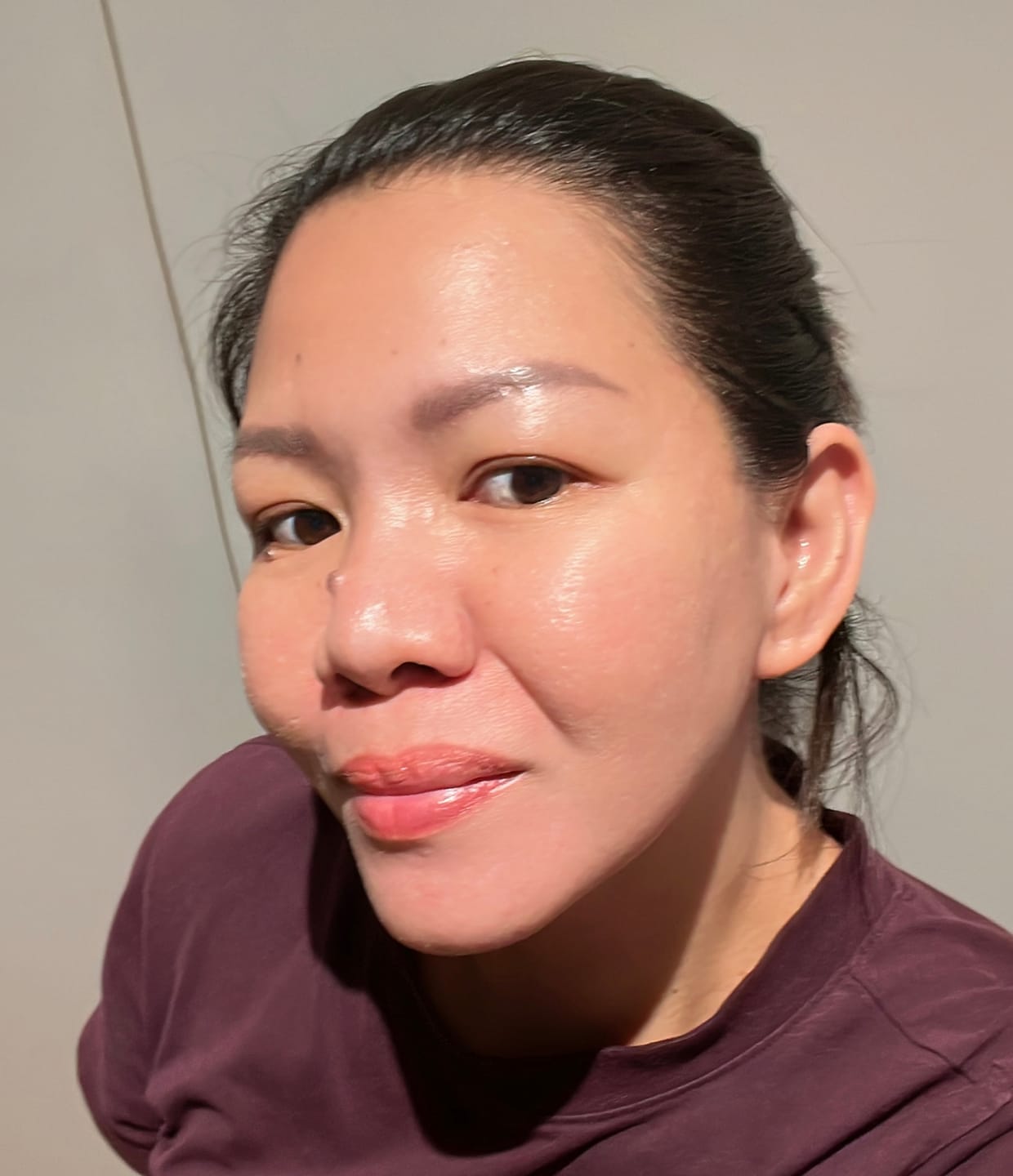 Customer photo review of PDRN Micro-Infusion Skin Booster