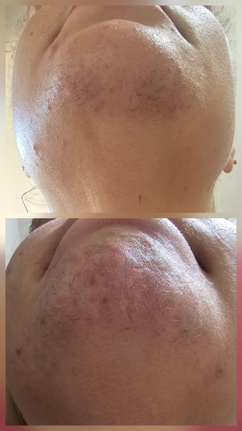 Customer photo review of Hair Reducing Fade Oil - Slows Growth, Thins, and Reduces Hair Naturally