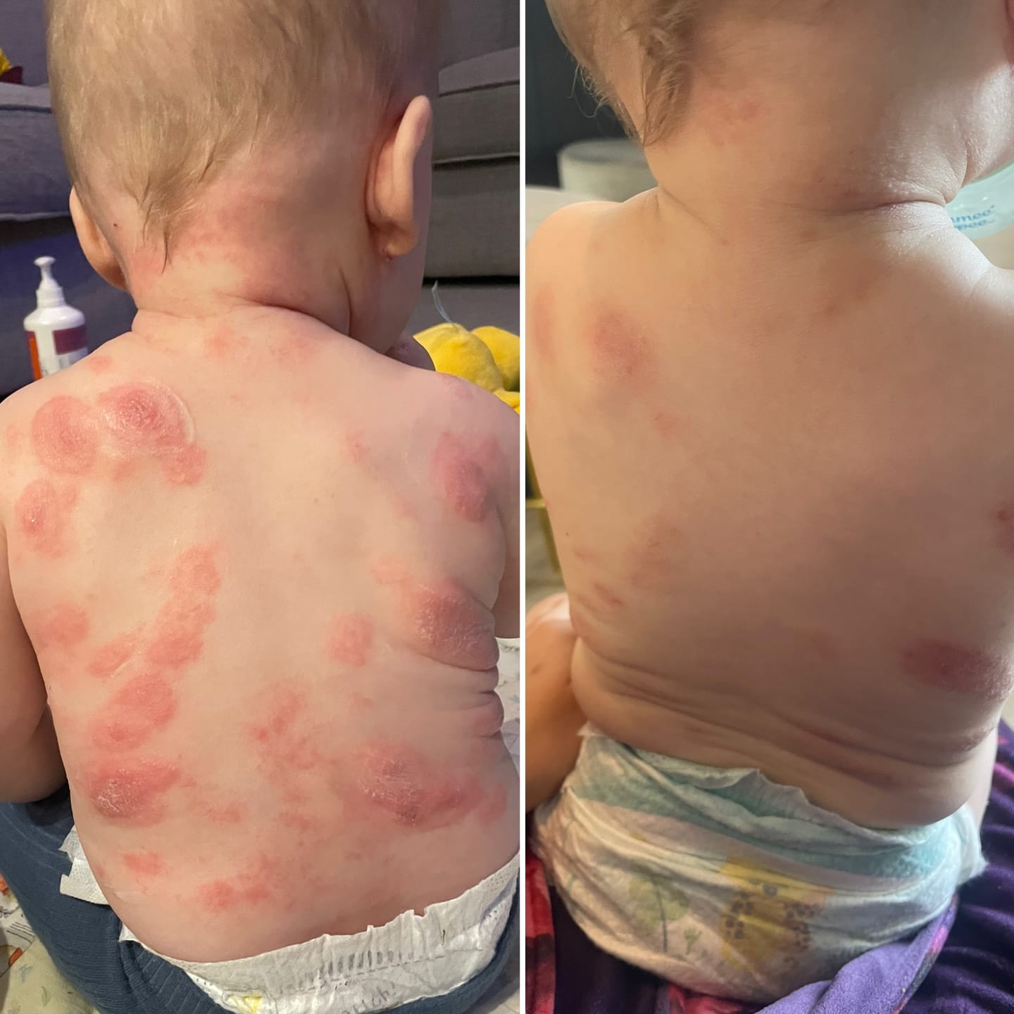 Customer photo review of Bioskin Junior Outbreak Rescue Cream