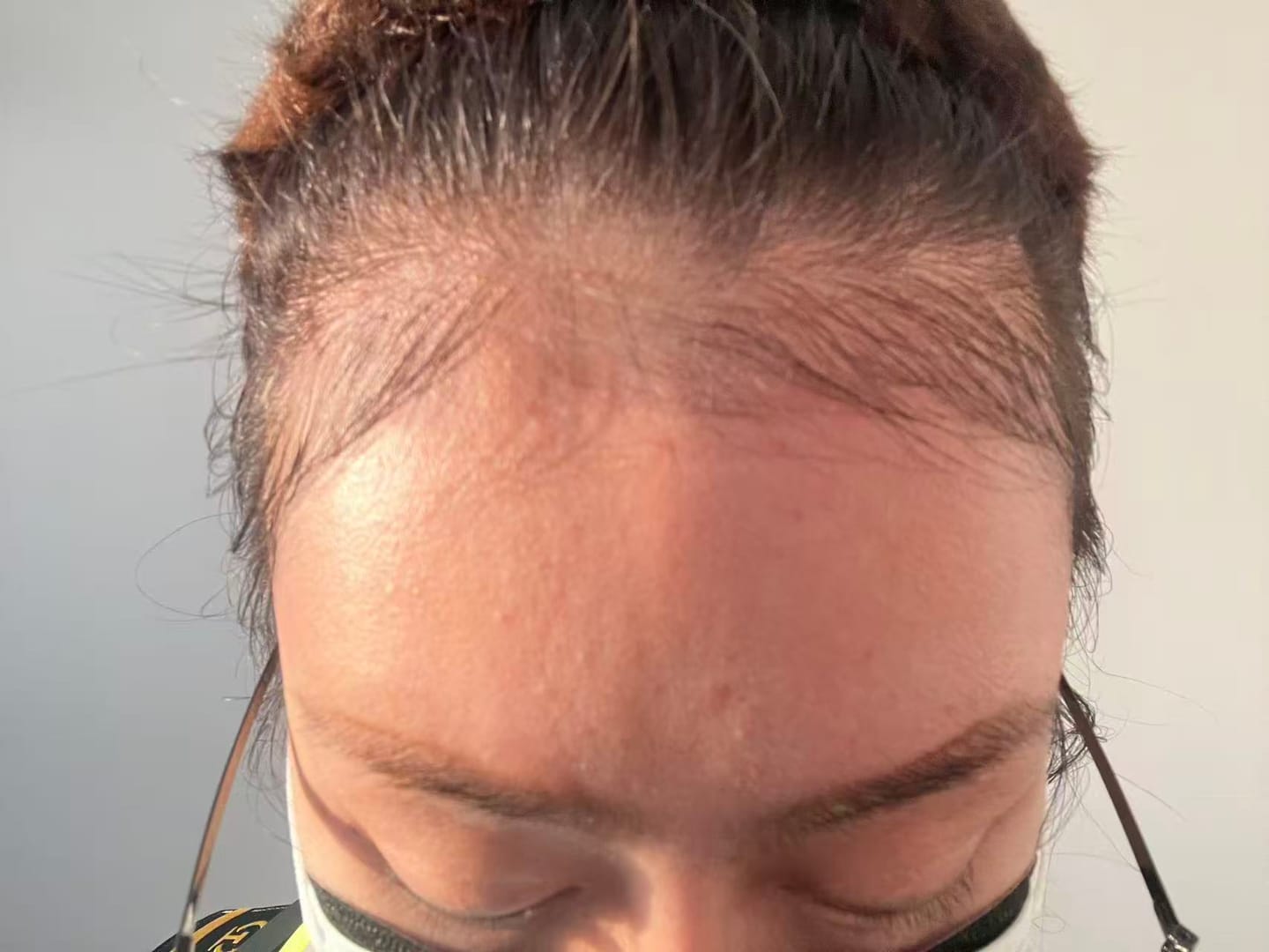 Customer photo review of [IN] Youth - Cure antichute cheveux