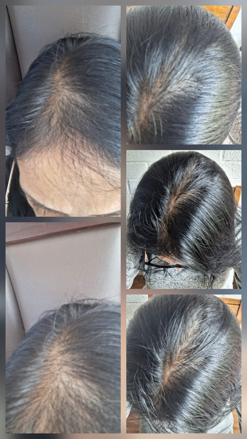 Customer photo review of DUO ANTIcaída CRECIMIENTO INTENSIVO Bomba + Tónico