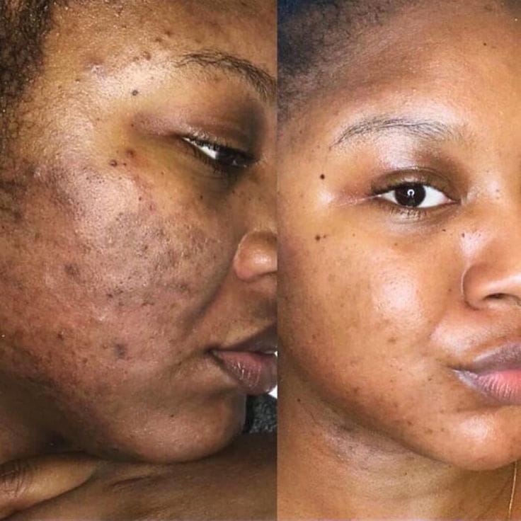 Customer photo review of Masque de nuit à l'acide kojique et au curcuma