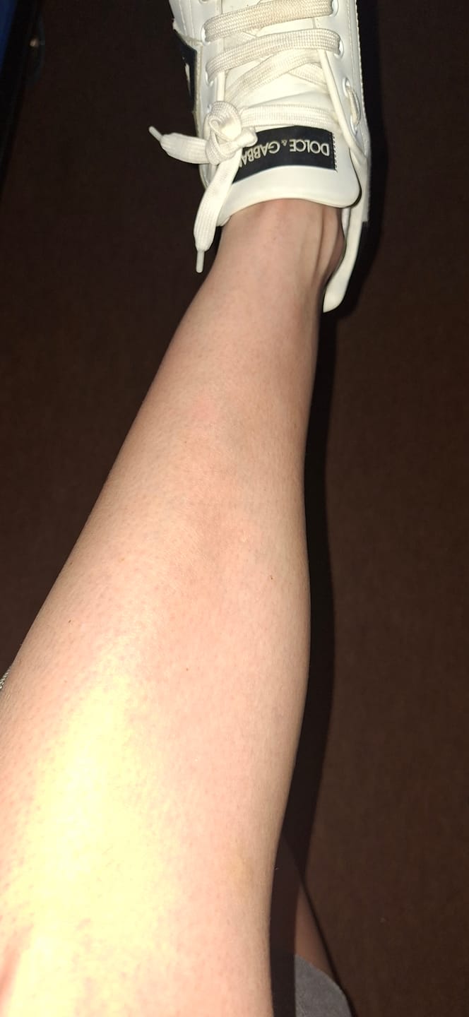 Customer photo review of 2x Belle Body Haarentfernung