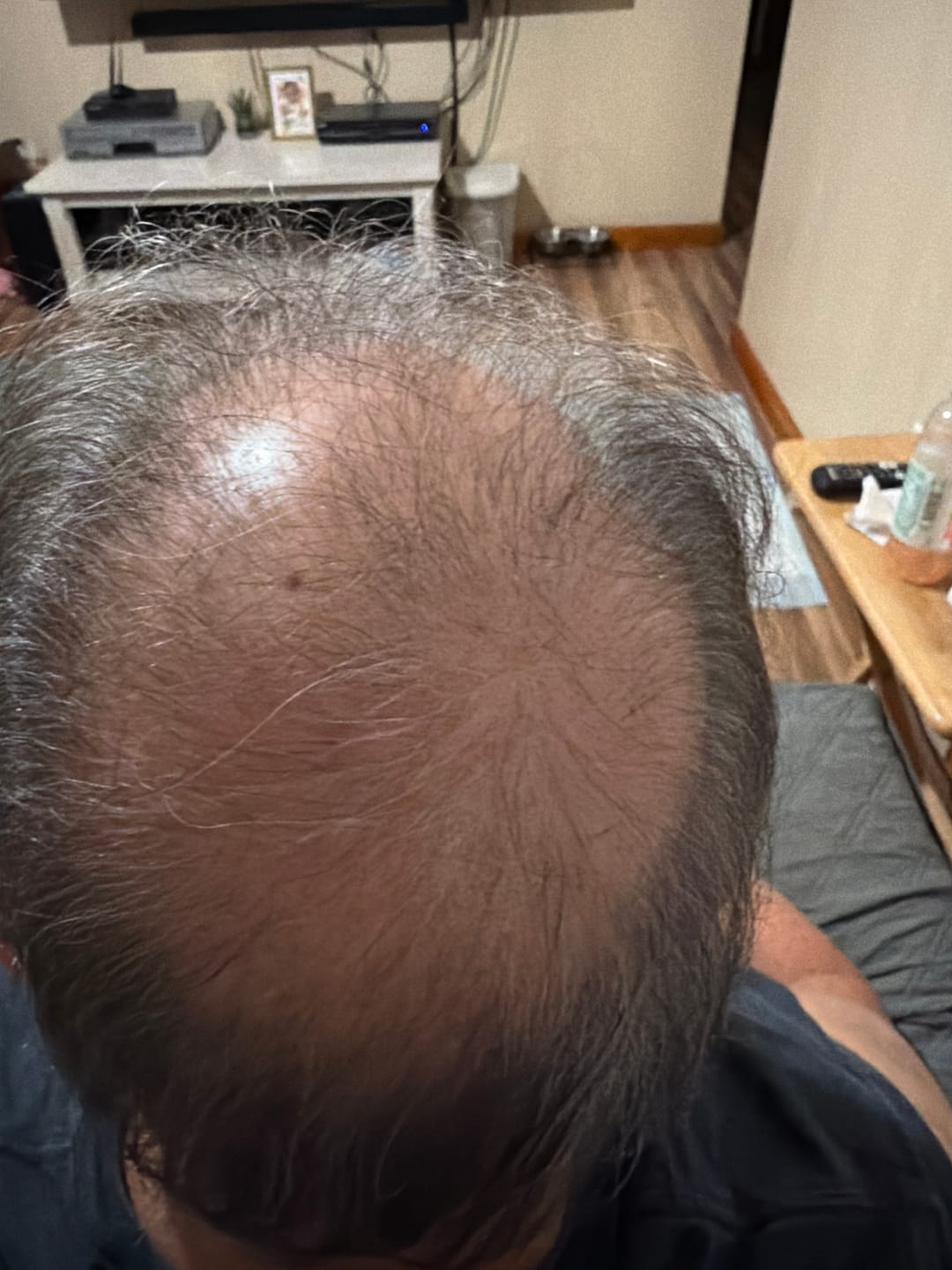Customer photo review of Micro Infusion System ck-s3m