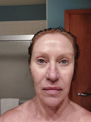 Reviewer showing their face after one treatment with The Micro Infusion System.