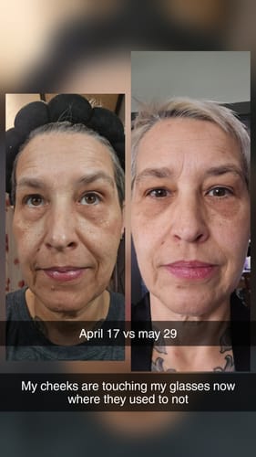 Reviewer's before-and-after photo showing fuller facial skin after using the Seranova Micro Infusion System.