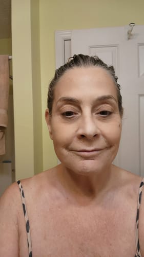 Customer showing their face after the first treatment with The Micro Infusion System.