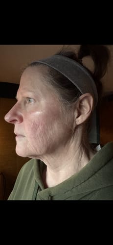 Customer's profile showing skin texture on their cheek and neck before using the Micro Infusion System.