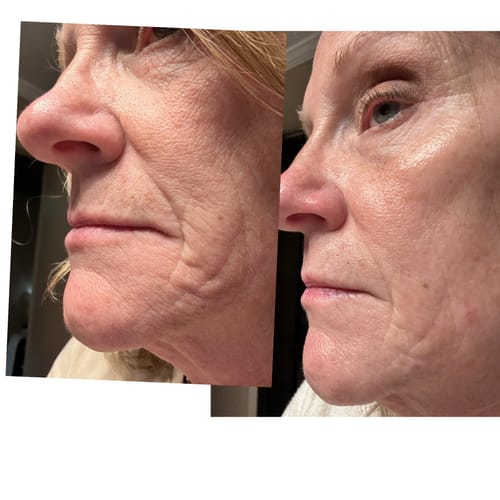 Customer's before-and-after image showing smoother skin after using the Seranova Microneedling System.