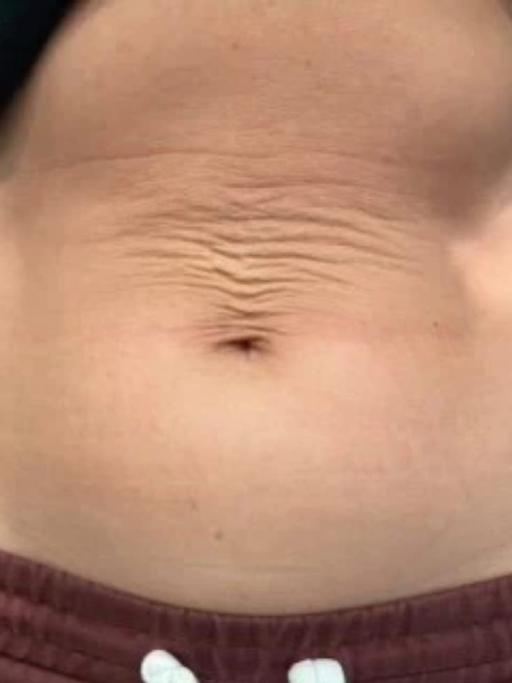 Customer photo review of Dispositivo de Moldeo Corporal Nova Sculpt