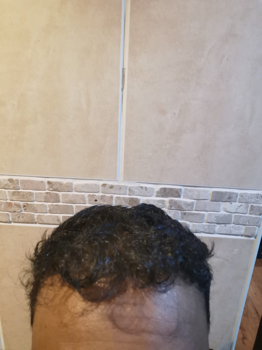 Customer photo review of Minoxidil DOUBLE ACTION Solution - MEN ONLY, 3x60ml pack