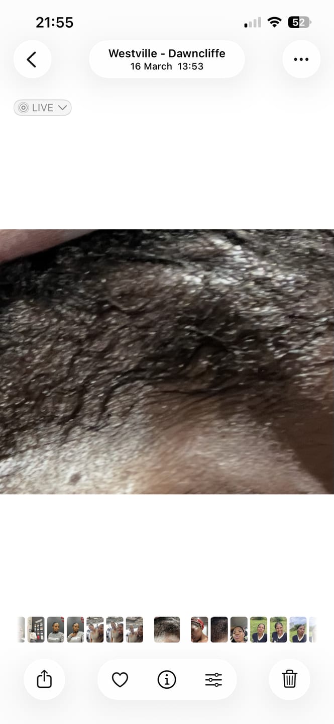 Customer photo review of Minoxidil REGULAR (2%) strength SOLUTION, 3x60ml pack