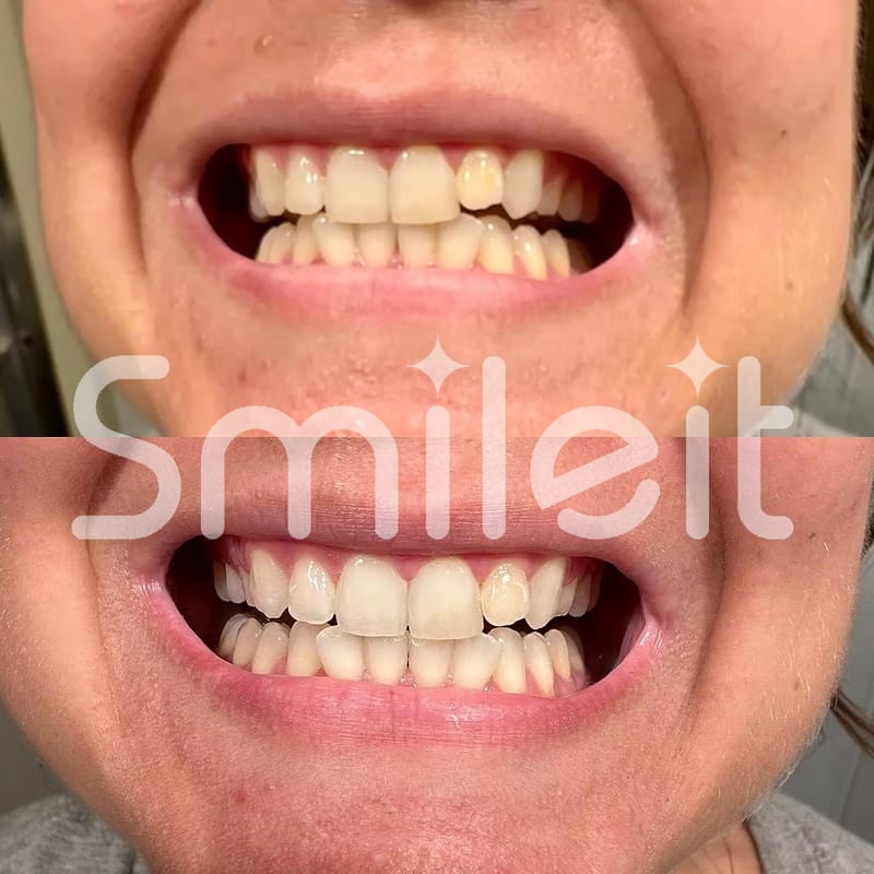 Customer photo review of פורמולת ההלבנה האינטסיבית של סמיילית