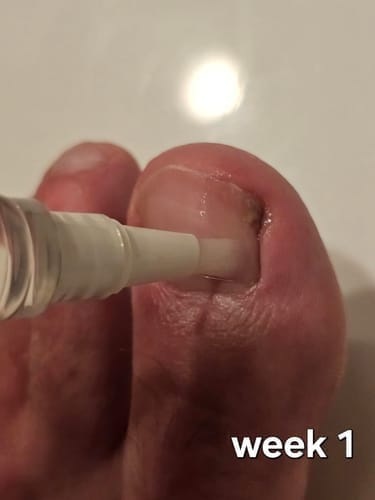Customer photo review of MyCurePro® · Elimina Fungos nos Pés e Mãos · 7 Dias
